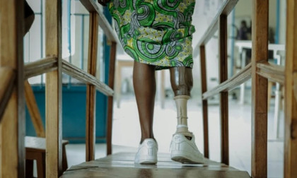 DR Congo’s amputees bear scars of years of conflict