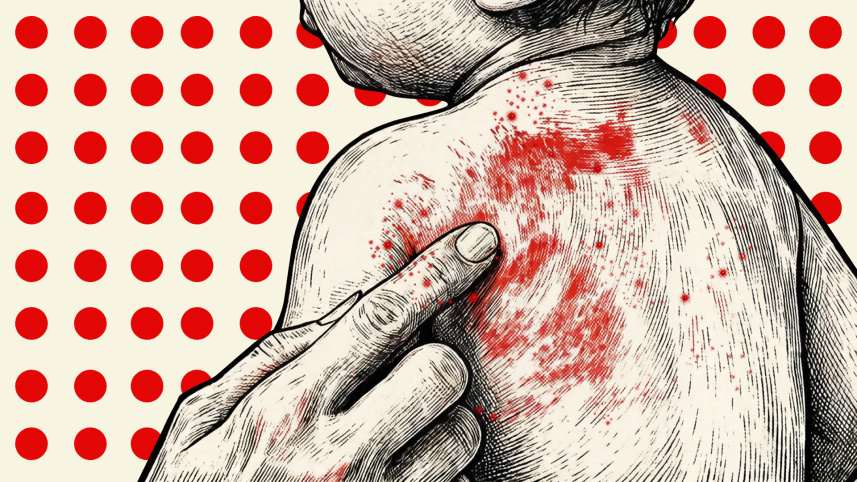 HC asks govt to explain measles deaths, vaccine shortage