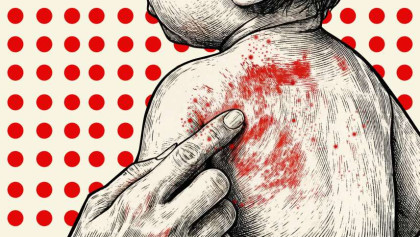 HC asks govt to explain measles deaths, vaccine shortage